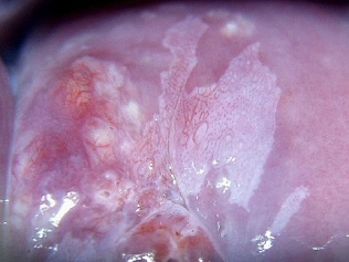 kolposkopia HPV